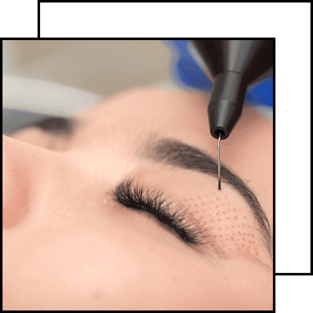 תמונה לטיפול הרמת עפעפיים