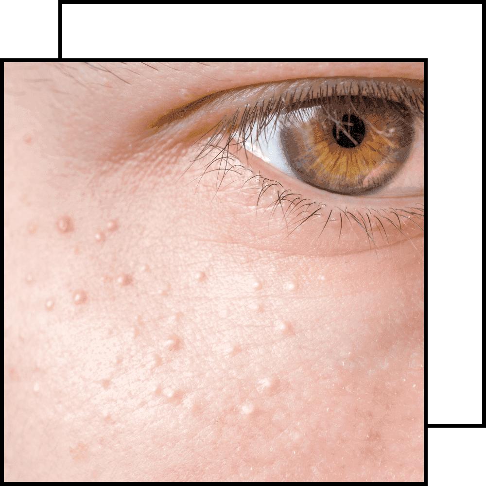 תמונה לטיפול הסרה של מיליומים