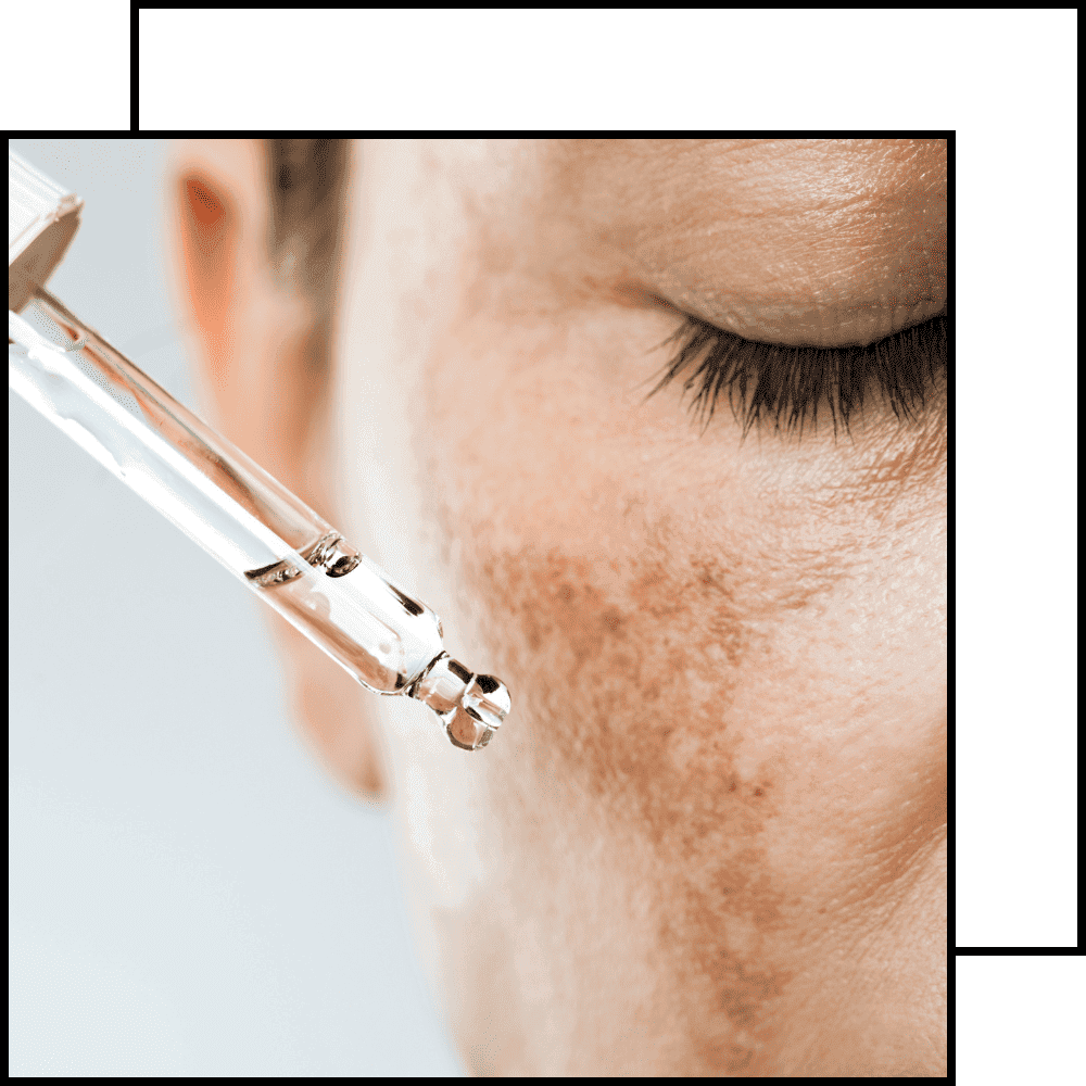 תמונה לטיפול פיגמנטציה