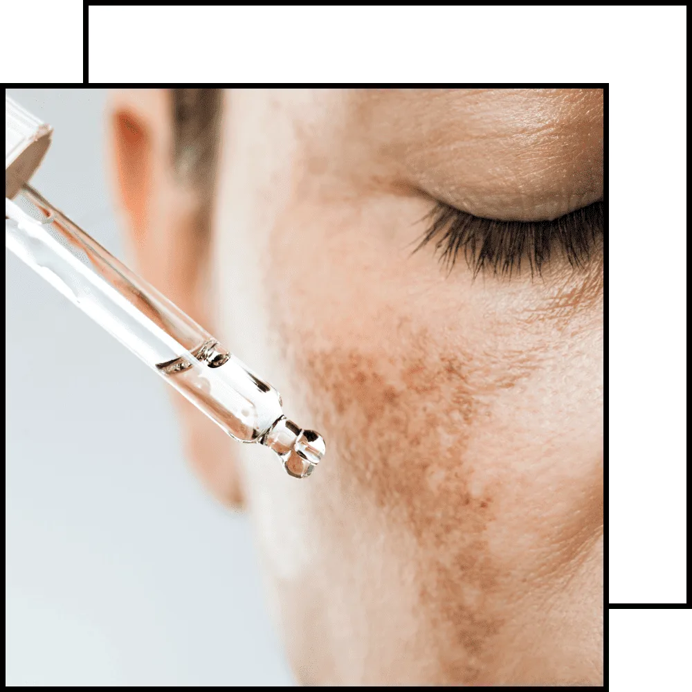 תמונה לטיפול פיגמנטציה