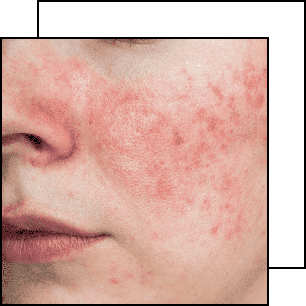 תמונה לטיפול ברוזציאה