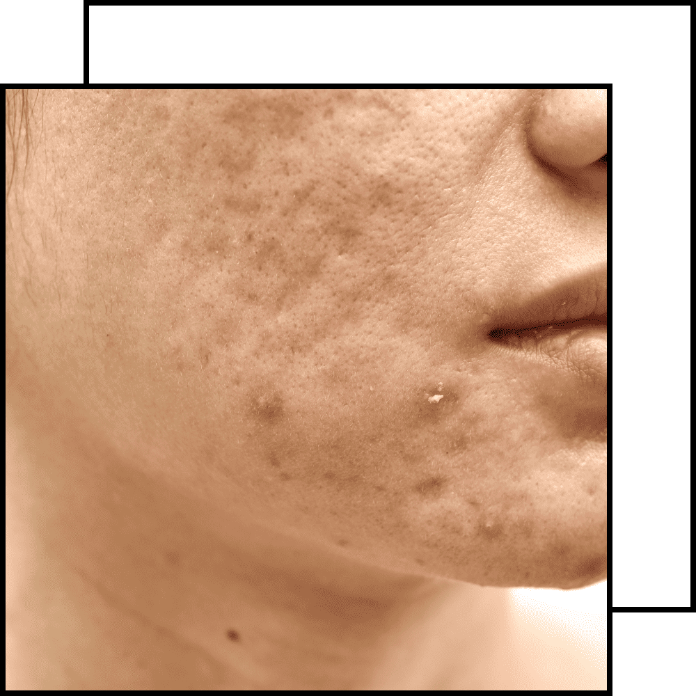 תמונה לטיפול בצלקות