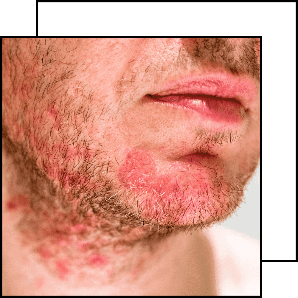 תמונה לטיפול בסבוריאה