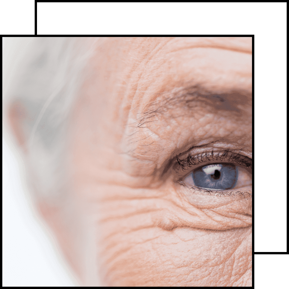 תמונה לטיפול בקמטים