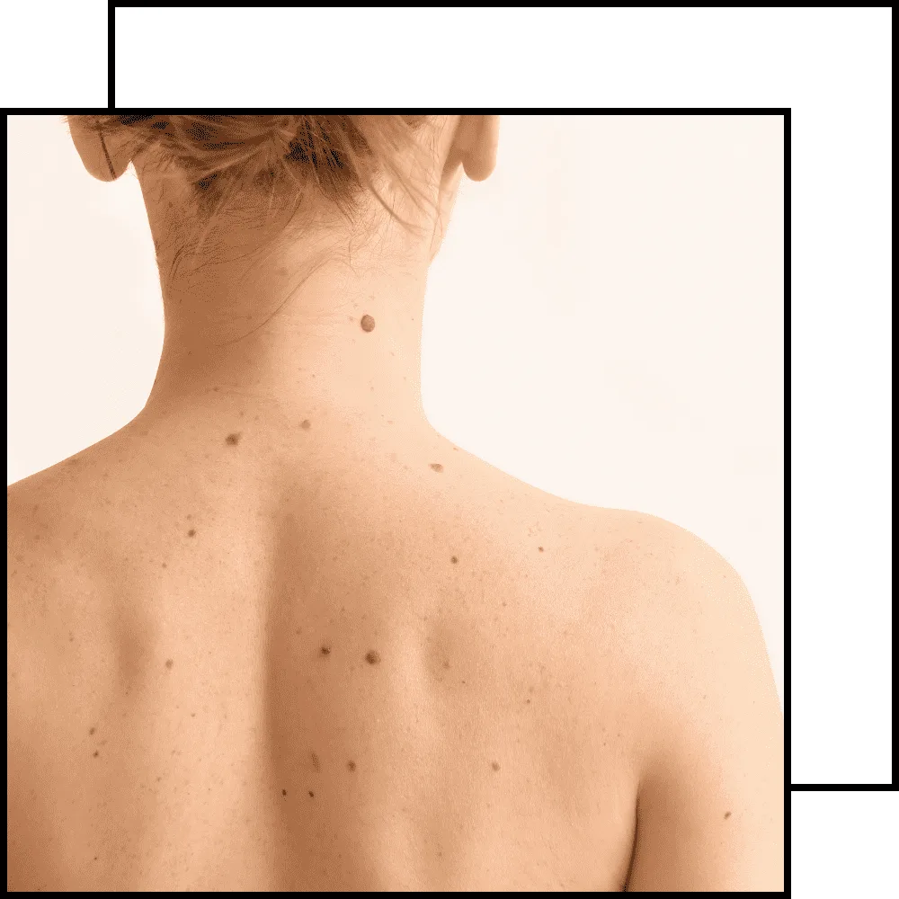 תמונה לטיפול הסרה של נגעים