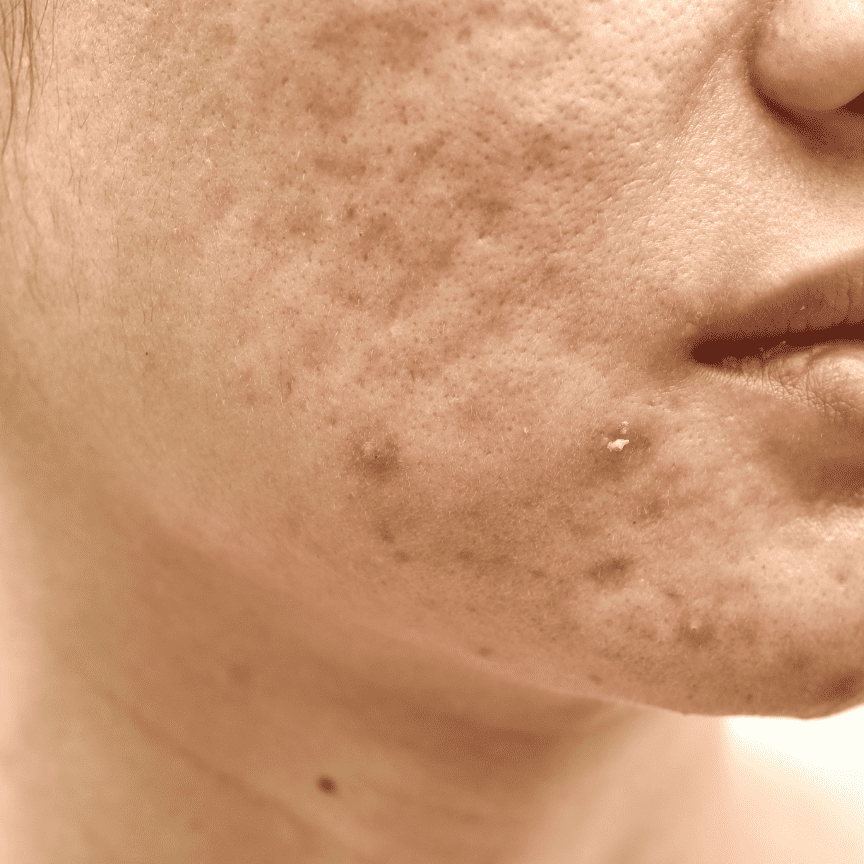 תמונה לטיפול בצלקות