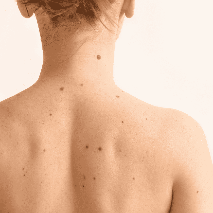 תמונה לטיפול הסרה של נגעים