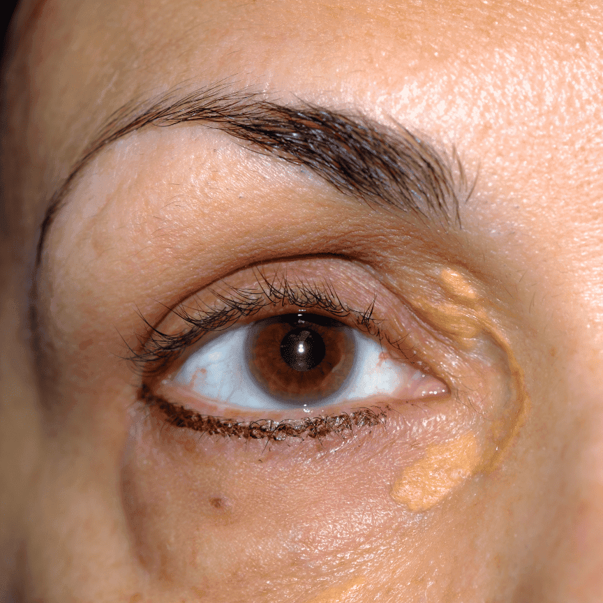 תמונה לטיפול הסרה של קסנטלזמה